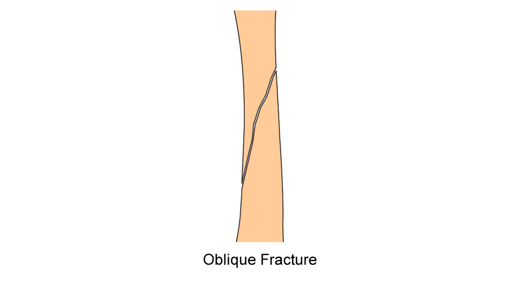 tibia diaphysis oblique fracture