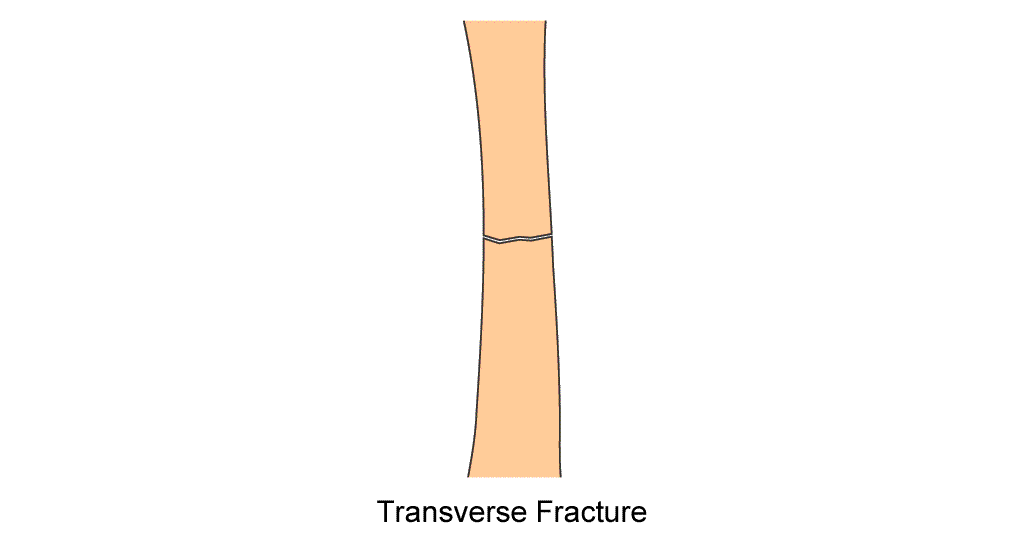 tibia diaphysis transverse fracture