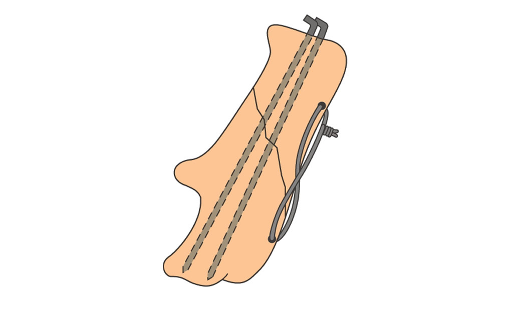 distal rear limb-calcaneus