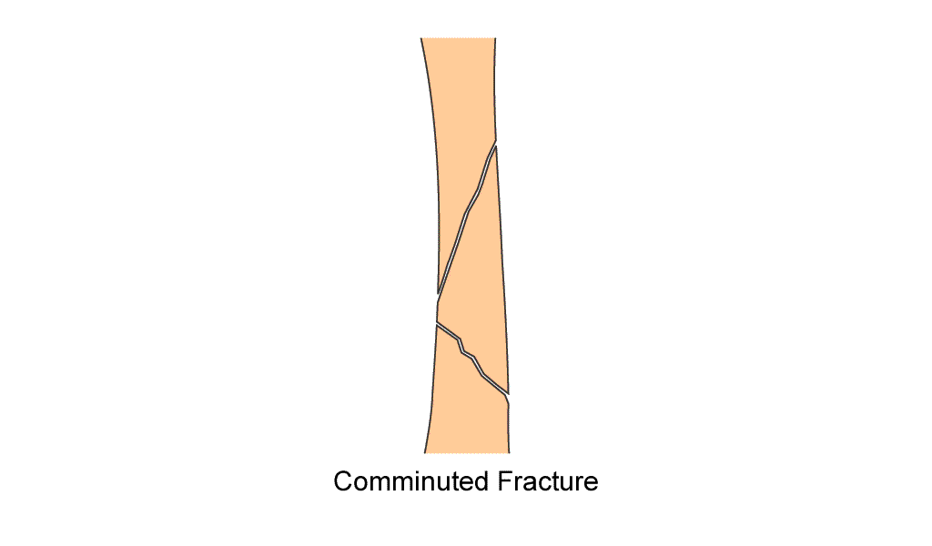 femur diaphysis comminuted fracture fix