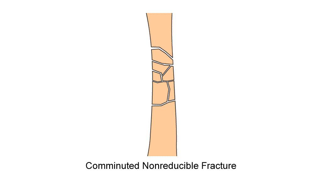 femur diaphysis comminuted nonreducible fracture fix