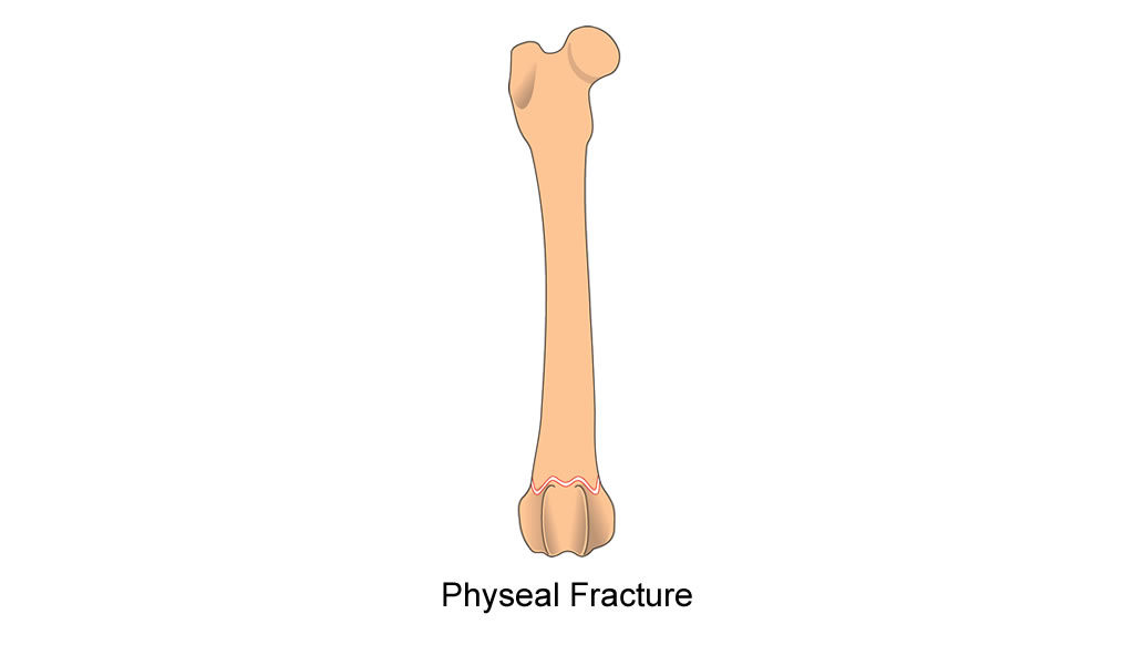 femur distal physis physeal fracture