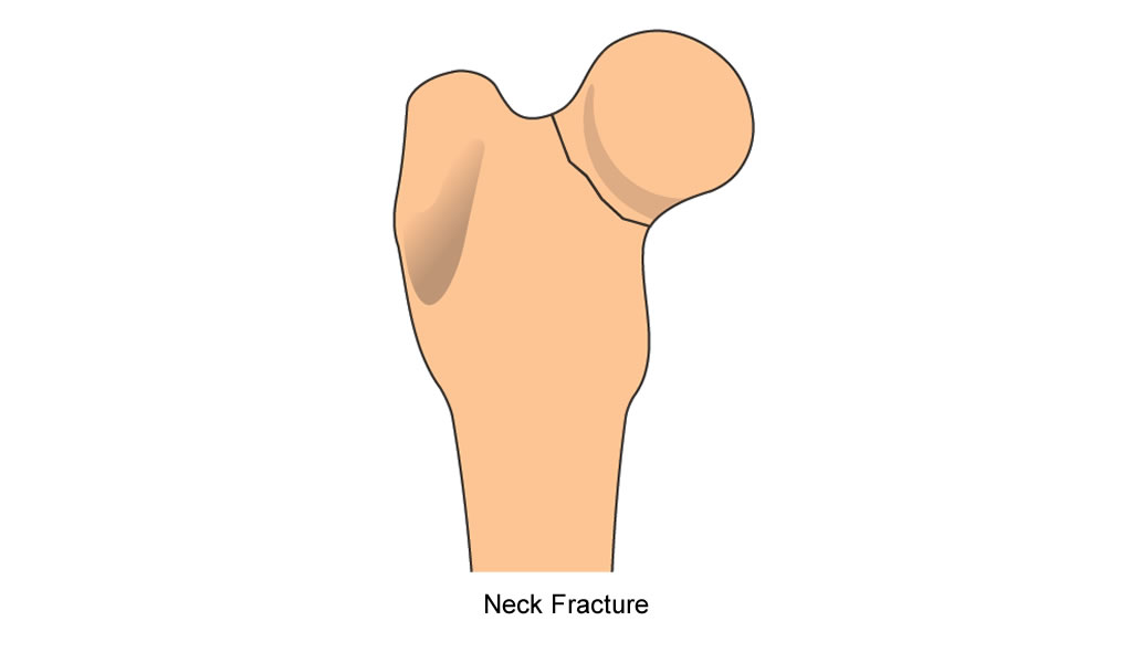 femur-neck fracture