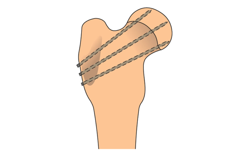 femur-physeal fracture