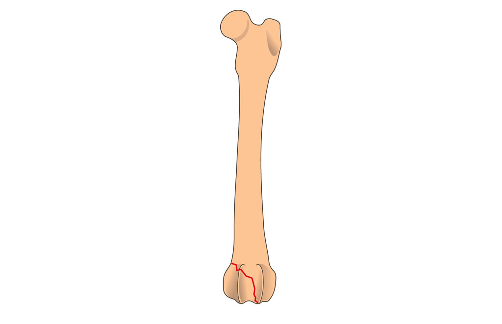 femur condylar fractures