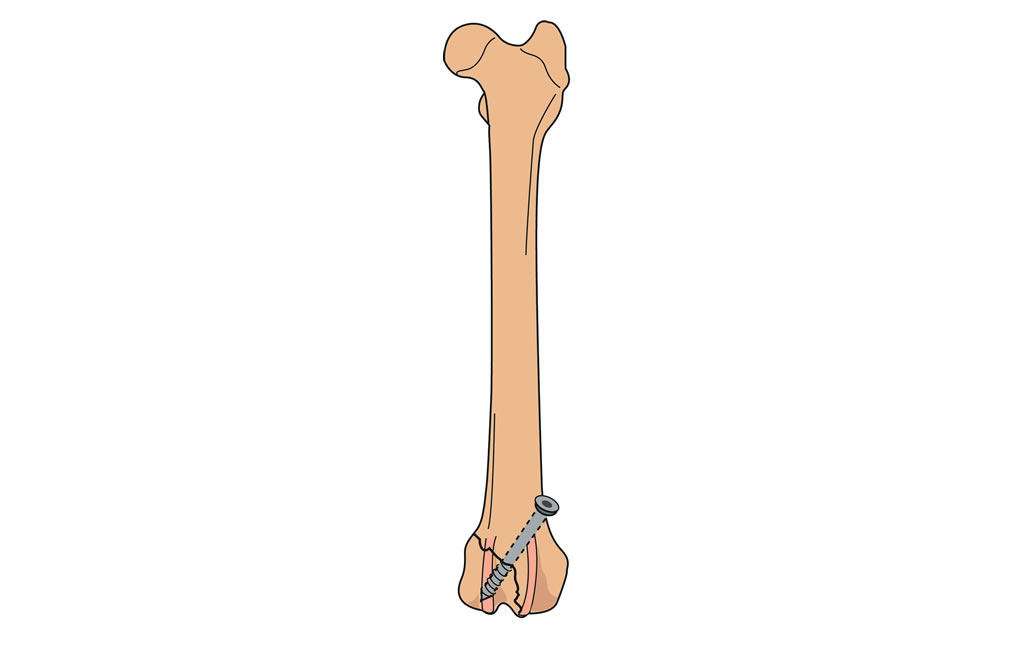 femur condylar fractures