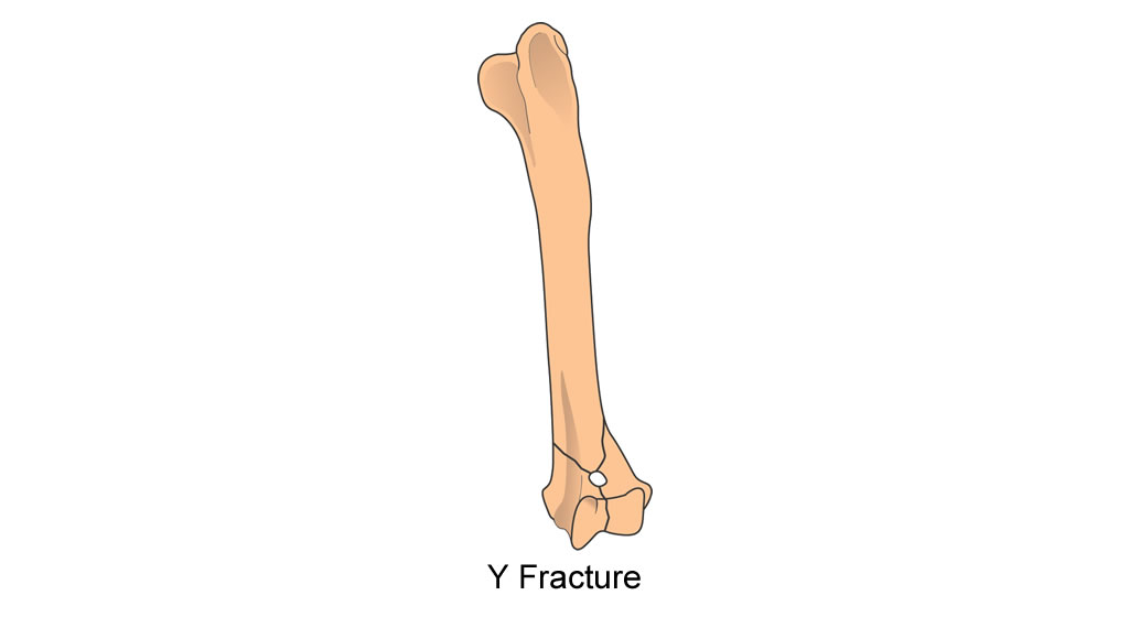 humerus articular Y fracture