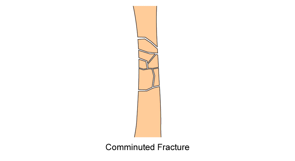 humerus_diaphysis_comminuted