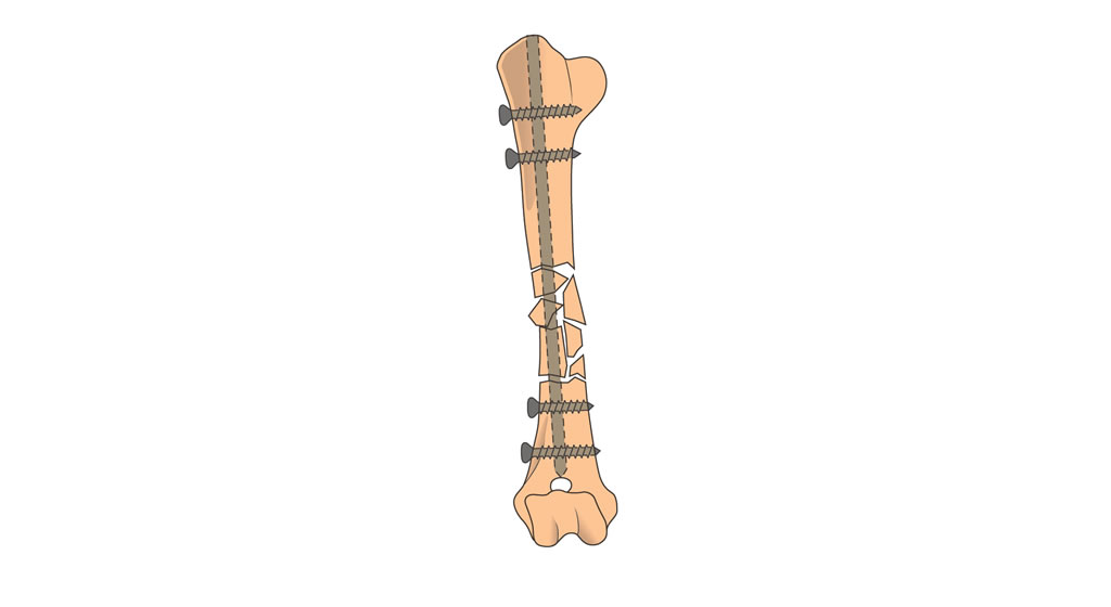 humerus diaphysis comminuted fracture fix