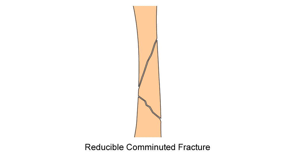 humerus diaphysis reducible comminuted fracture