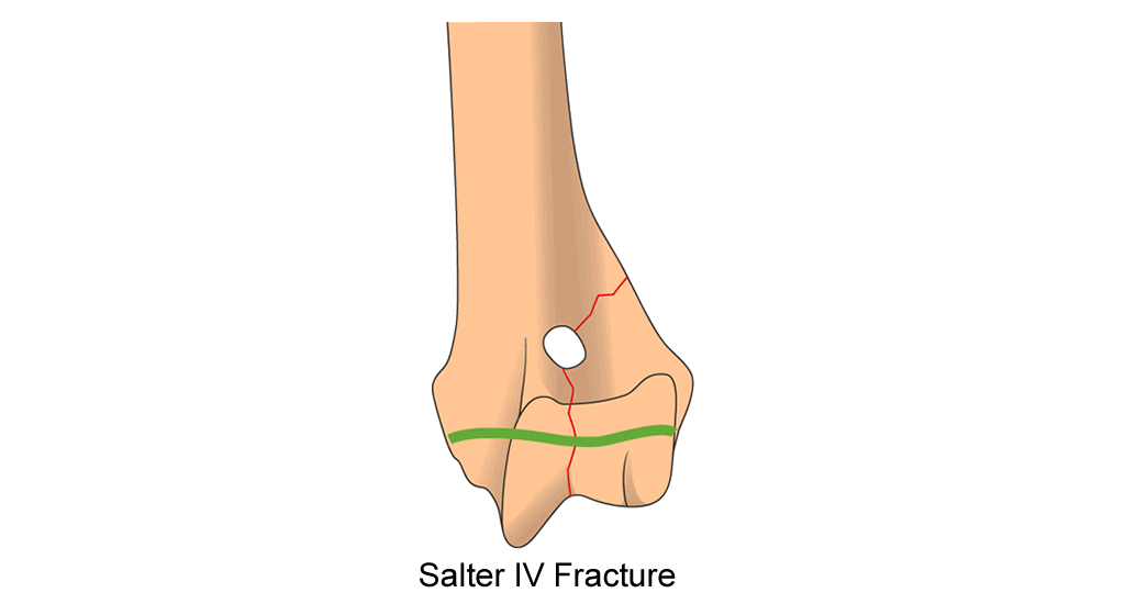 humerus distal physis condylar fracture