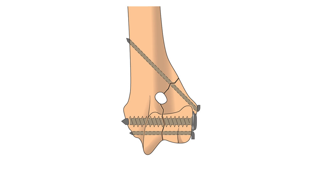 humerus distal physis condylar salter IV fracture