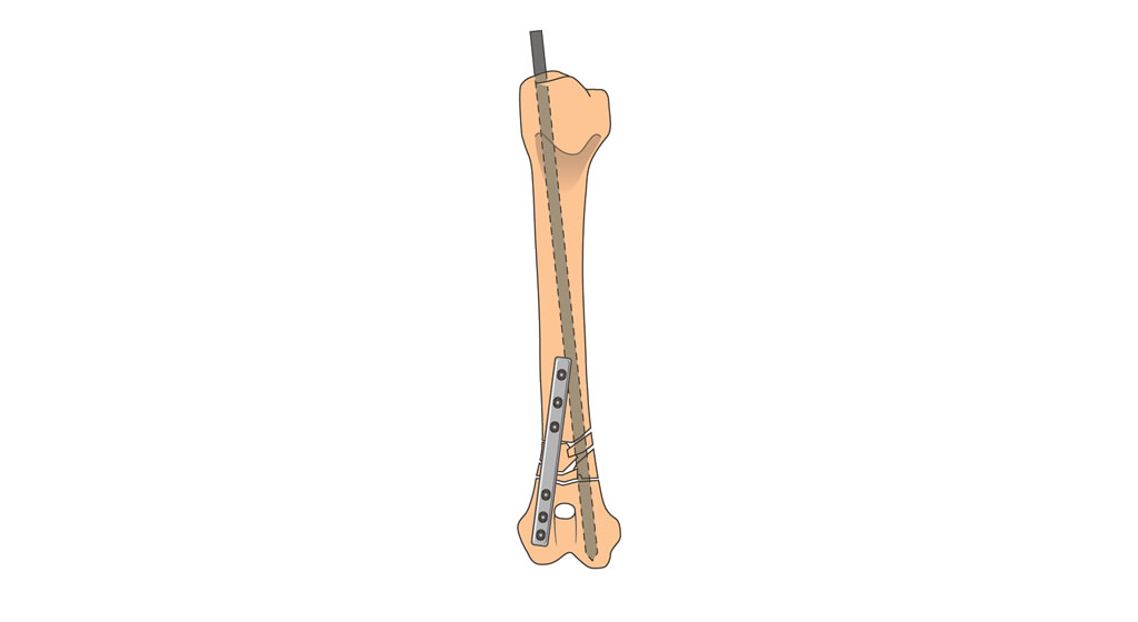 humerus supracondylar comminuted fracture