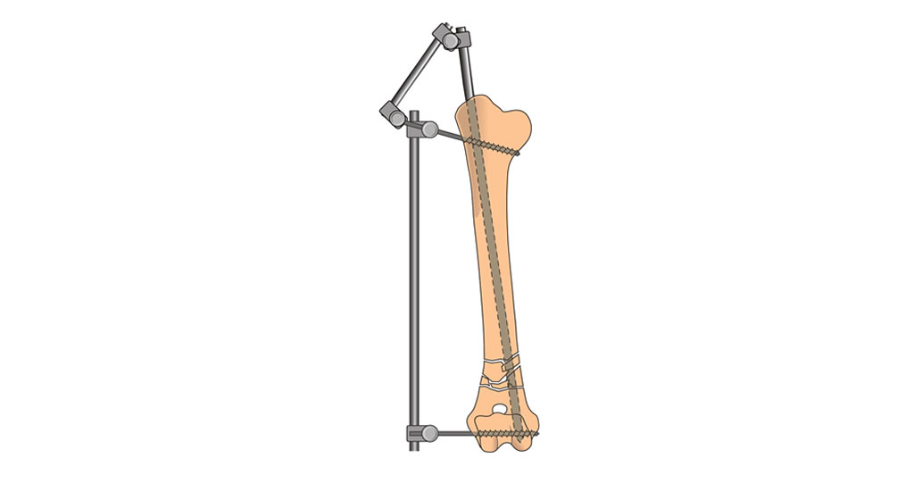 humerus supracondylar comminuted fracture