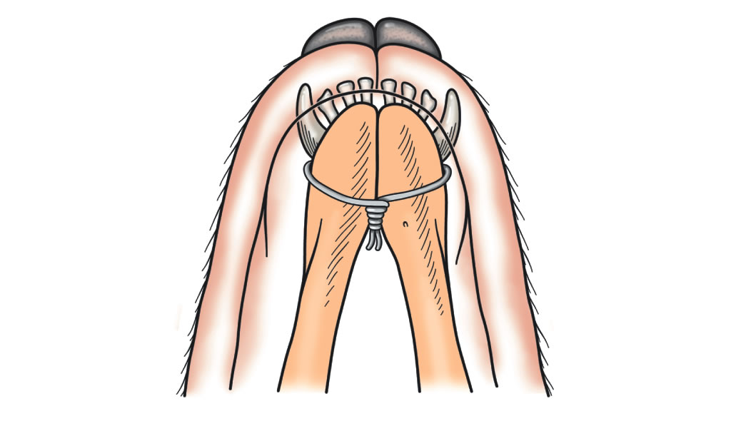 mandible symphyseal fracture
