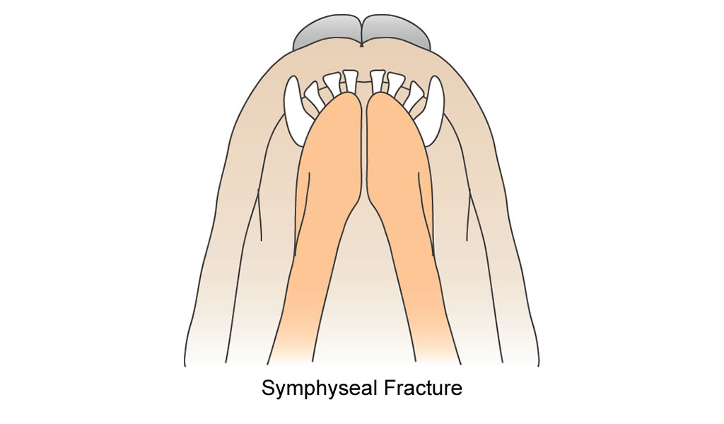 mandible symphyseal fracture