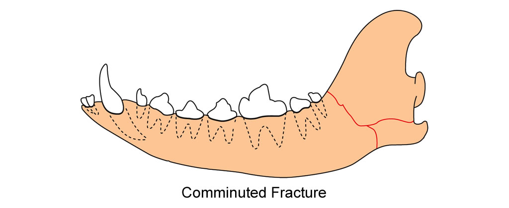 mandible ramus comminuted fracture