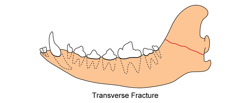 mandible ramus transverse fracture