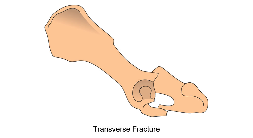 pelvis acetabulum transverse fracture