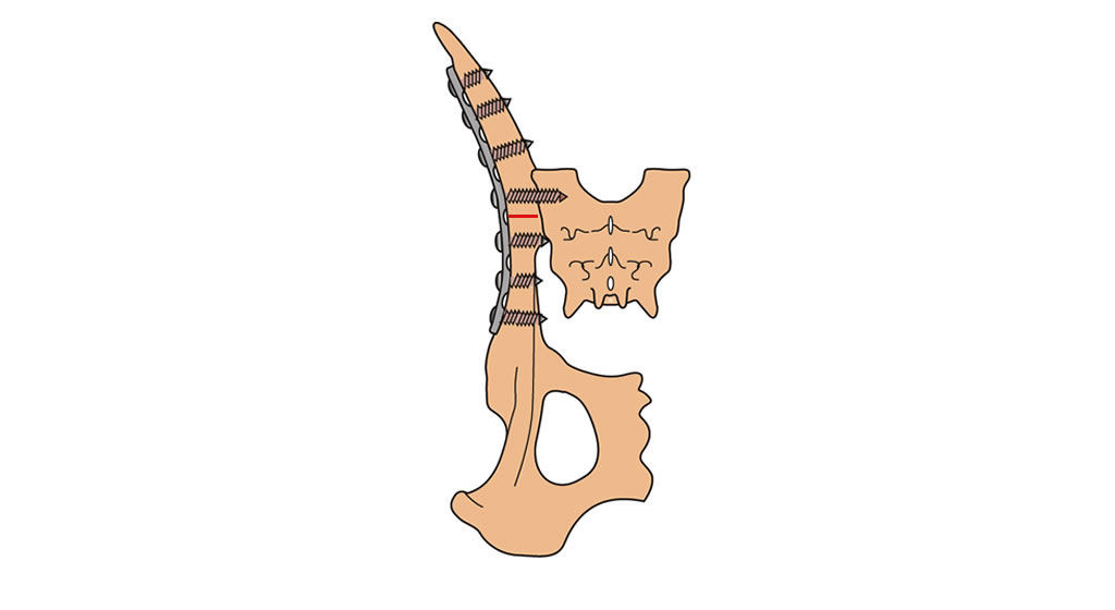 pelvis body oblique fracture