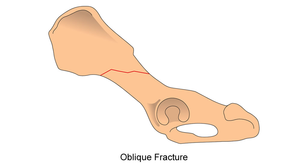 pelvis body oblique fracture fix
