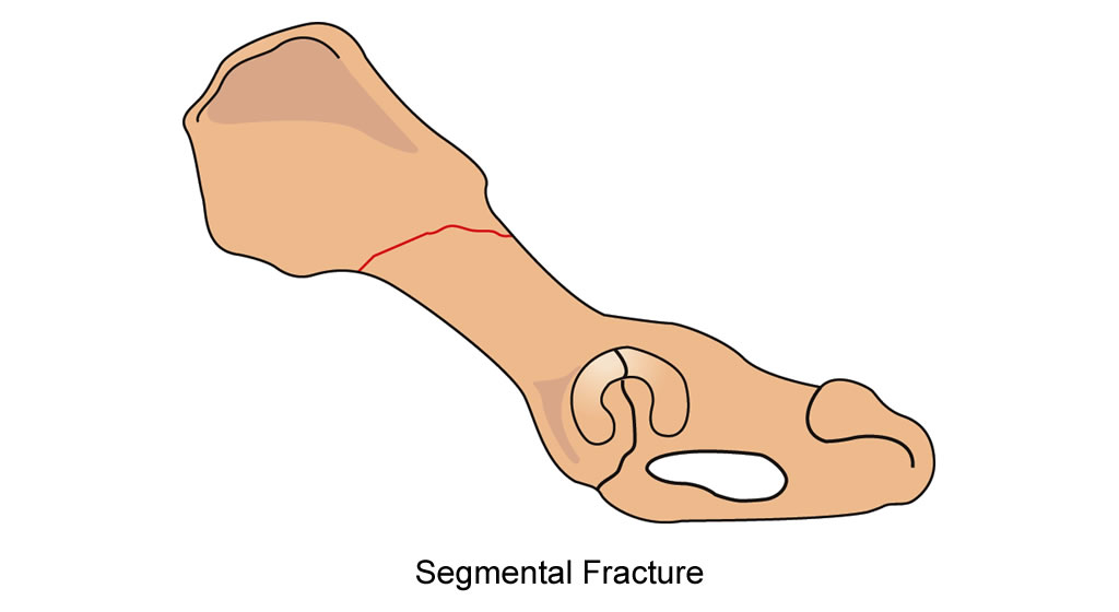 pelvis body segmental fracture