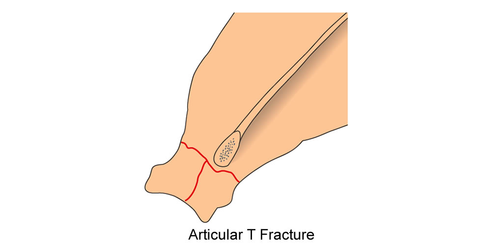 scapula articular T