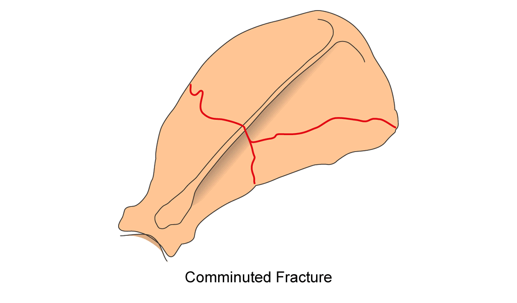 scapula body comminuted fracture