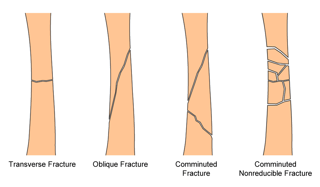 tibia diaphysis fractures