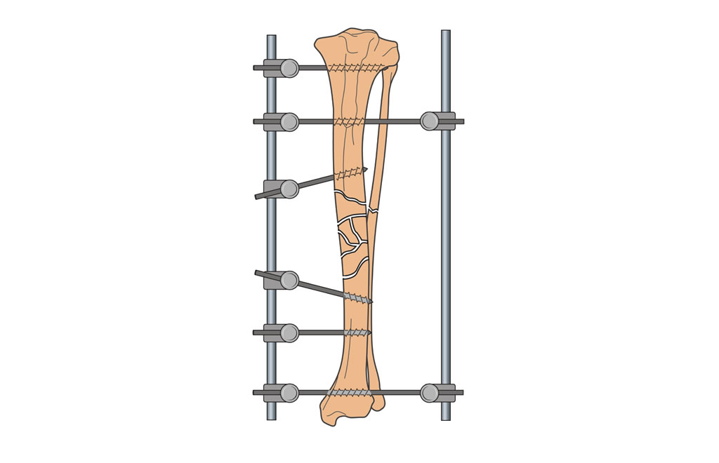tibia diaphysis comminuted nonreducible fracture