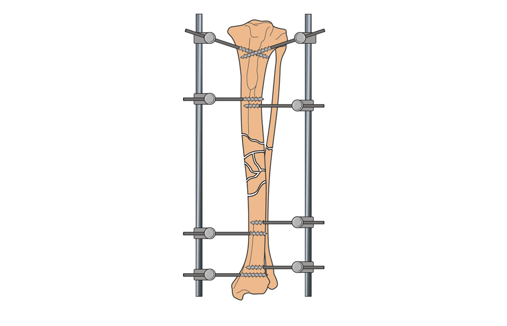 tibia diaphysis comminuted nonreducible fracture