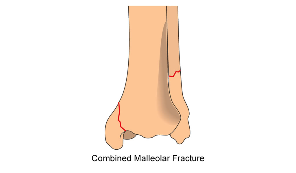 tibia distal articular combined malleolar fracture