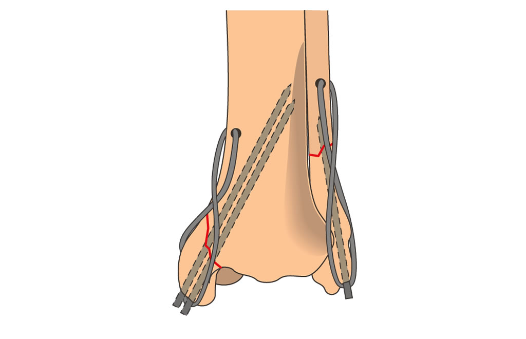 tibia distal articular combined malleolar fracture
