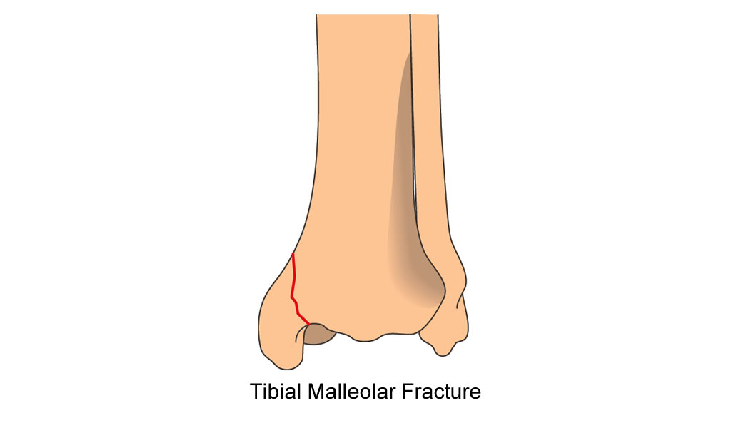 tibia distal articular fibular fracture