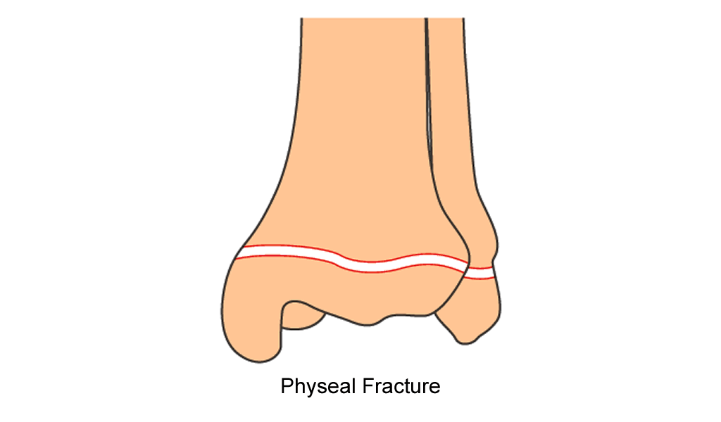 tibia distal physis physeal fracture